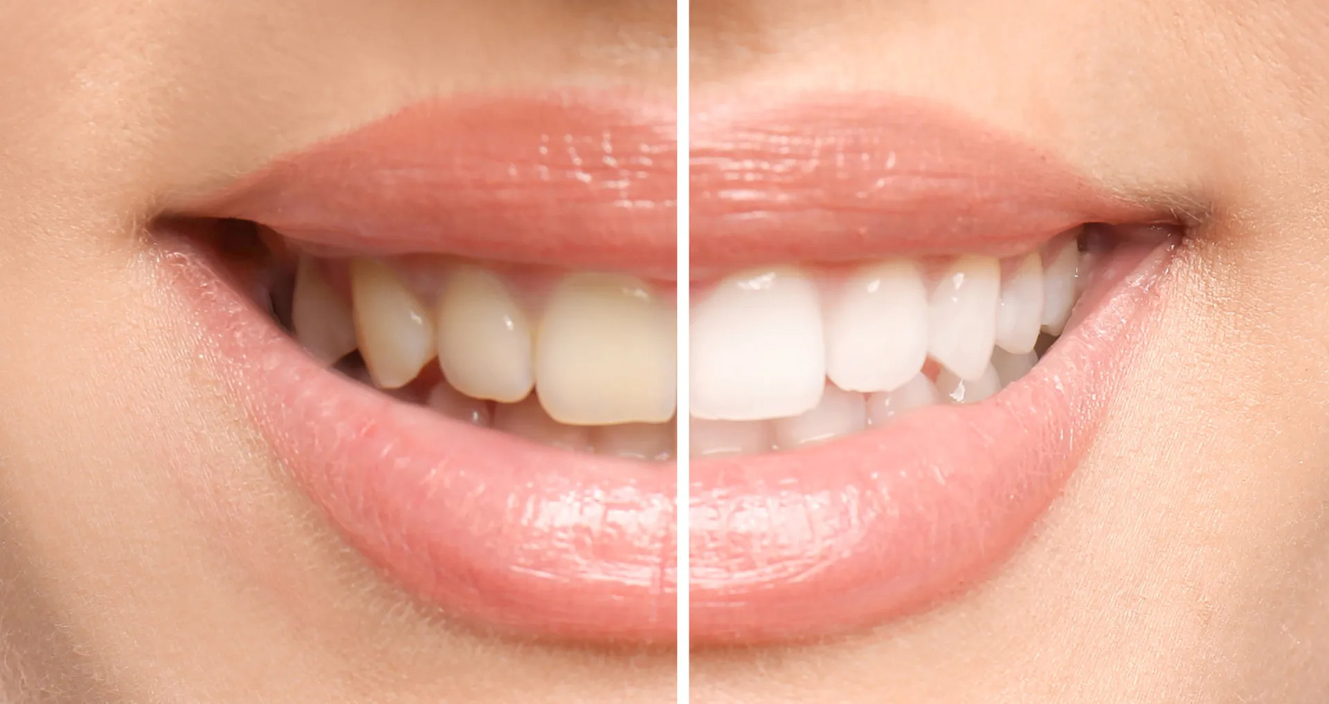 Teeth Whitening in San Diego | Aero Dentistry