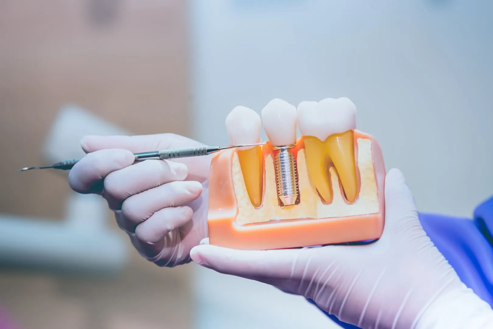Dental Implants in Kearny Mesa